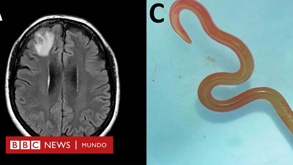 Un gusano vivo en el cerebro de una mujer y otras 4 noticias de salud que causaron impacto en 2023