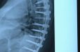 New robotic spine surgery offers hope for severe scoliosis cases