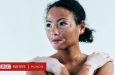 Vitiligo, la enfermedad de la piel que a pesar de ser común es muy poco conocida